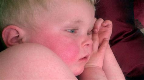 Scarlet Fever Cases Shoot Up By 300 In Kent Prompting Public Health