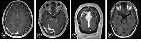 Figure 3 From A Rare Case Of Hypertrophic Pachymeningitis After Surgery