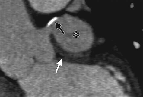 Coronary Artery Aneurysms And Ectasia Role Of Coronary Ct Angiography