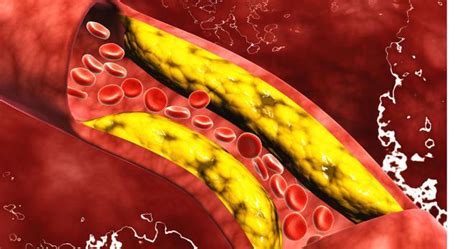 Factores De Riesgo Que Pueden Afectar Al Colesterol Merca2