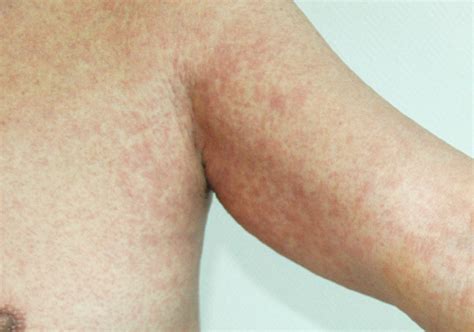 Diffuse Maculo Papular Rashes Are Observed On Chest And Arms