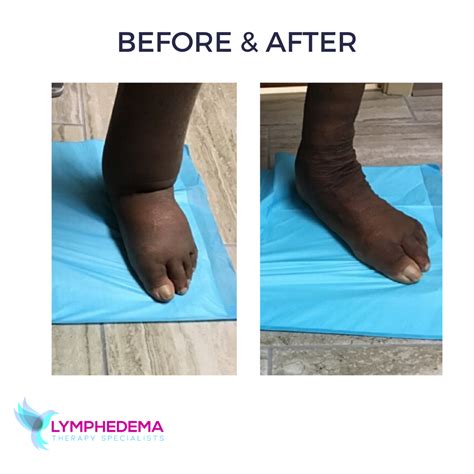 before and after lymphedema therapy specialists