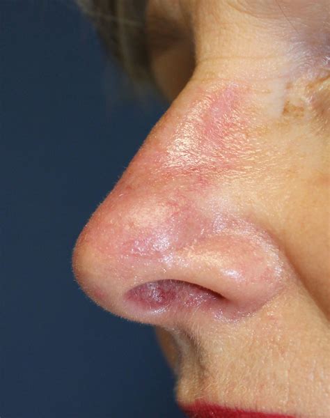 Basal Cell Carcinoma Nose
