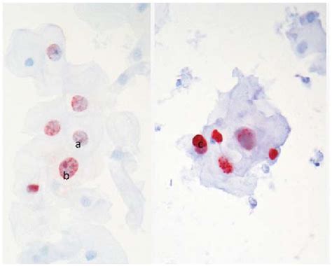 Immunocytochemical Reactivity To HPV L1 Capsid Protein In Squamous