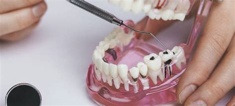 Danville Cavity Treatment Pro Smile Dental Care