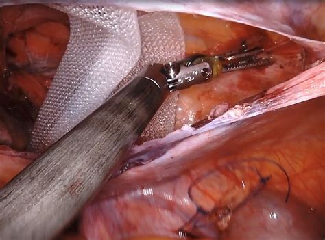 Robotic Assisted Right Scrotal Hernia Repair With Mesh
