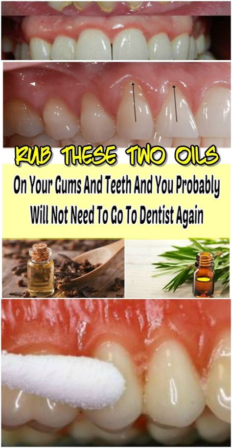 Rub These Two Oils On Your Gums And Teeth And You Probably Will Not