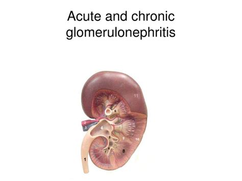 Ppt Acute And Chronic Glomerulonephritis Powerpoint Presentation