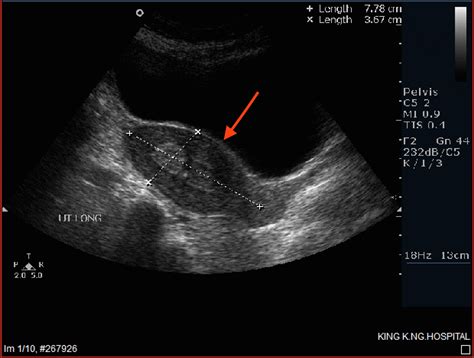 Cureus A Rare Medical Dilemma Presentation And Management Of Placental Polyp