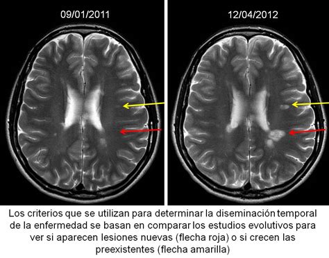 3 de 4esclerosis múltiple i. Esclerosis Multiple Resonancia Magnetica : Biomarcadores ...