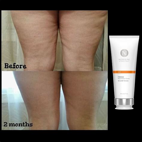 list 92 pictures goodbye cellulite before and after pictures completed