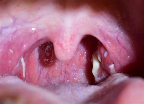 They're usually soft but they can harden. Tonsil Stones: Everything You've Ever Wanted to Know About ...