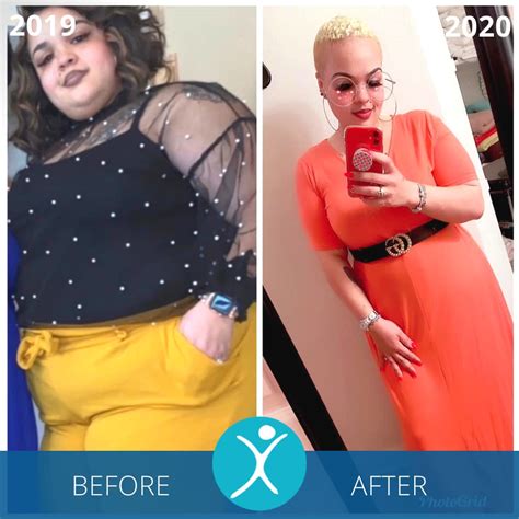 Gastric Sleeve Surgery Before And After Before And After Photos Centra Health Central Virginia