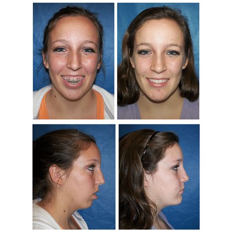 Before And After Photos Maxillofacial Surgery