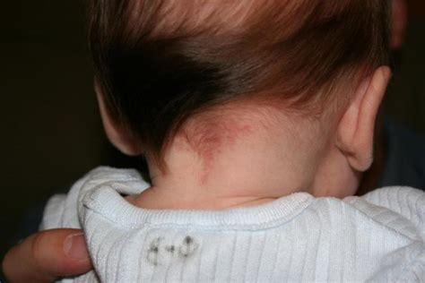 Different Birthmark Types Causes And Risks Babychakra