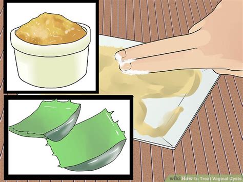 How To Treat Vaginal Cysts Steps With Pictures Wikihow