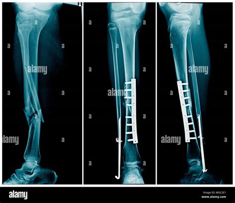 X Ray Leg Fracture With Post Operation Internal Fixation Tibia Bone
