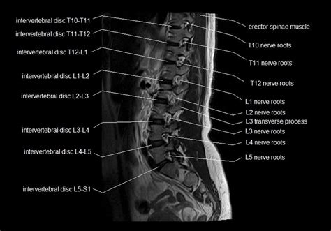 Mri Lumbar Spine Sagittal Cross Sectional Anatomy Image 5 Anatomy
