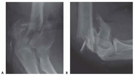 Elbow Replacement For Acute Trauma Musculoskeletal Key