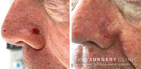 Basal Cell Carcinoma BCC Skin Cancer Removal Leeds Bradford Before And After Photos A Skin