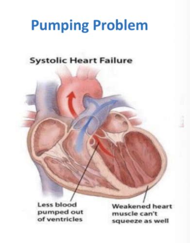 Heart Failure Flashcards Quizlet