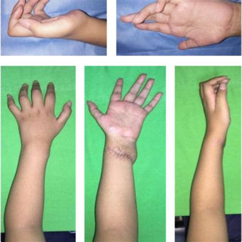 Treatment Options For Claw Hand Deformity In Ulnar Nerve Palsy