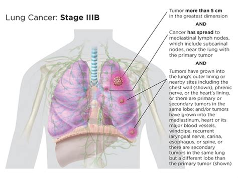 The higher the number, the larger the cancer tumor and the more it has spread into nearby tissues. Lung Cancer Staging | LUNGevity Foundation
