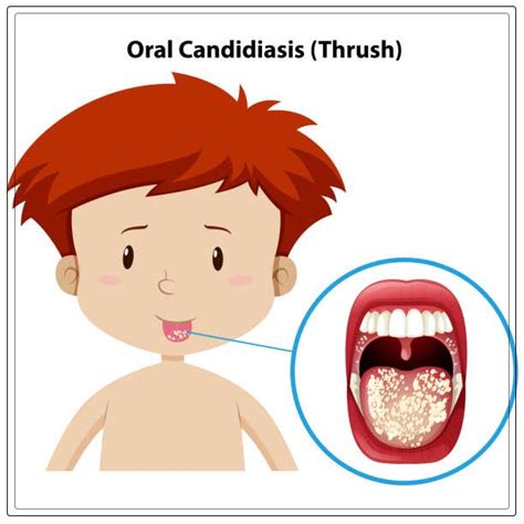 Oral Thrush Symptoms Treatment And Prevention Dentist Ahmed