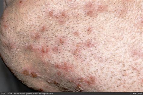 Stock Image Dermatology Sycosis Barbae Multiple Red Rounded And