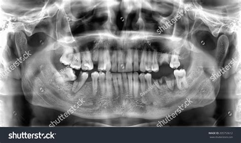 Original Panoramic Dental Xray Image Teeth Stock Photo 205753612