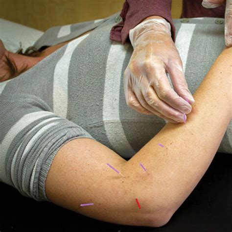 Dry Needling Services Physical Therapy In Motion Billings Mt