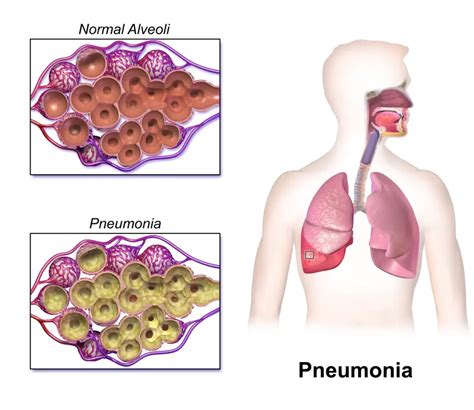 Pneumonia Causas Sintomas E Tratamentos Isso Funciona