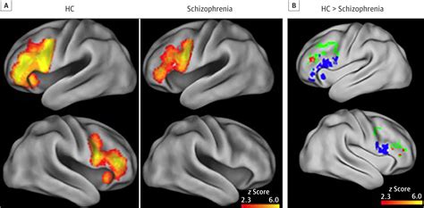 Functional And Neuroanatomic Specificity Of Episodic Memory Dysfunction In Schizophrenia A