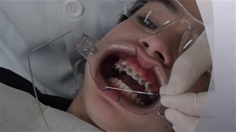 Tracionamento De Canino Incluso