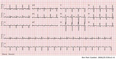 Late Atypical Atrial Flutter After Ablation Of Atrial Fibrillation