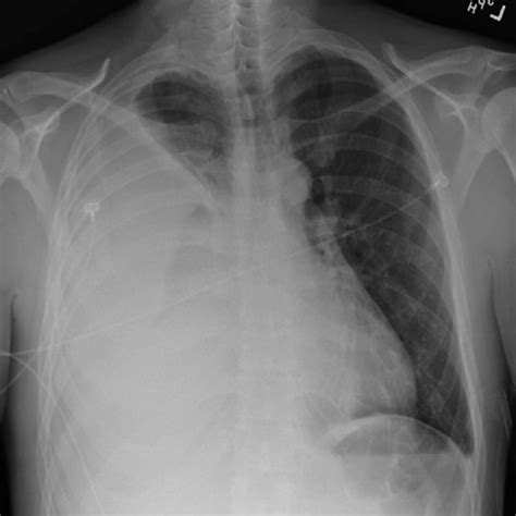 Chest Radiograph Pa View Showing Opacification Of The Right Hemithorax