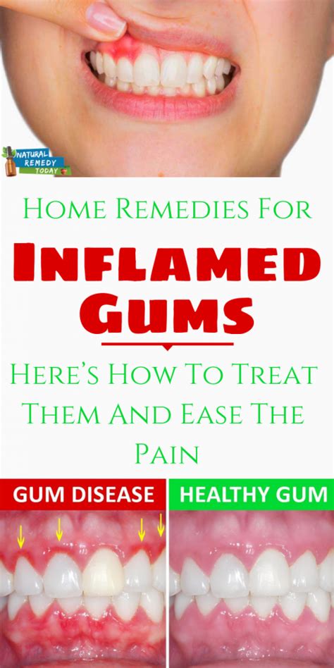 Swollen Gums Remedy Home Remedies For Gum Swellingtop 10 Natural