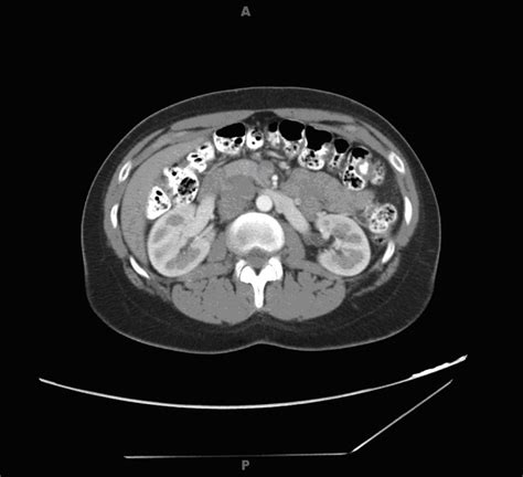 Abdominal Computed Tomography Scan Showing Right Paracaval Mass