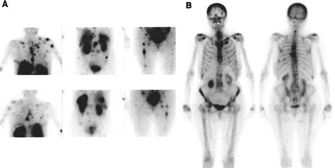 Bone Metastases In Carcinoid Tumors Clinical Features Imaging