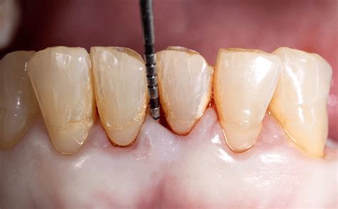 Periodontal Tissue Regeneration Management Of Periodontal Defects