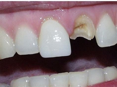 Dental Photos Before And After Dr Dove Dental Office