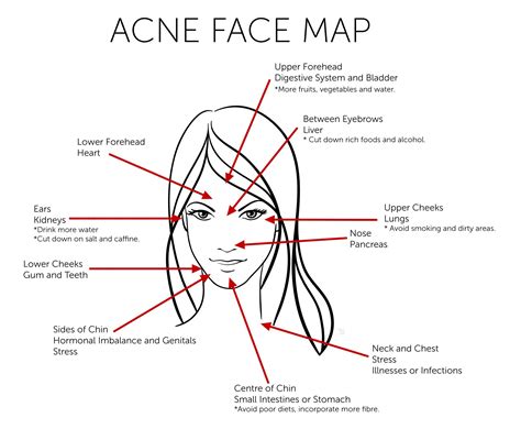 Acne Face Map What Acne Revealing About Your Health With Images Face Mapping Acne Face