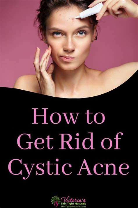 Cystic Acne How To Get Rid Of It Skin Tight Naturals Cystic Acne