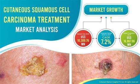 Cutaneous Squamous Cell Carcinoma Treatment Market To See Booming