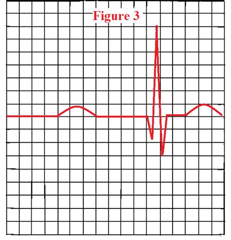 How To Measure The Pr Interval On An Ekg Strip Pr Interval Ekg Quiz