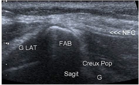 Common Peroneal Nerve Imaging Findings With An Emphasis On Ultrasound
