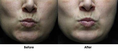 Botox Before And After Lip Lines Before And After