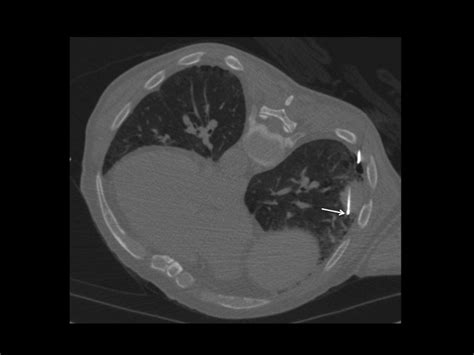 12mm Nodule Lung