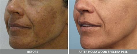 Microneedling Before And After Melasma Before And After