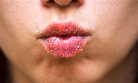 Dry Lip Treatments 3 Ways To Treat Your Clients Chapped Lips